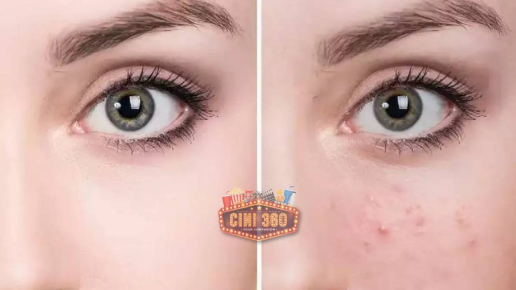 முகப்பரு பிரச்னையா